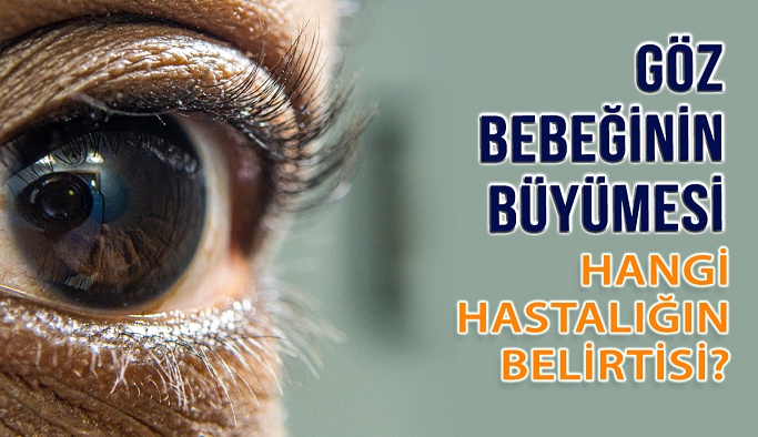 Göz Bebeğinin Büyümesi Hangi Hastalığın Belirtisi?