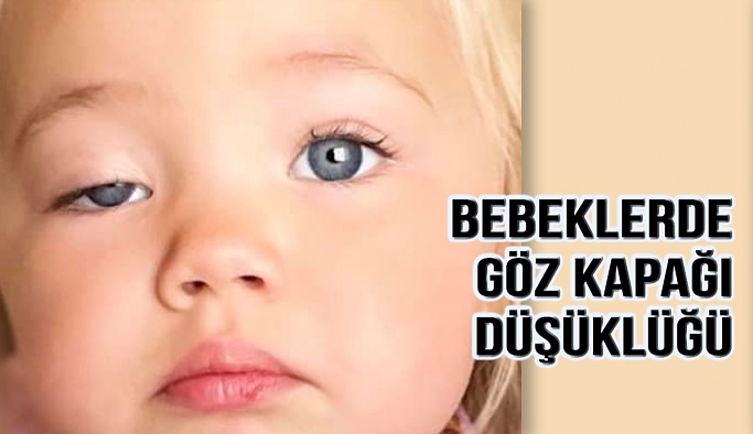 Bebeklerde Göz Kapağı Düşüklüğü Neden Olur