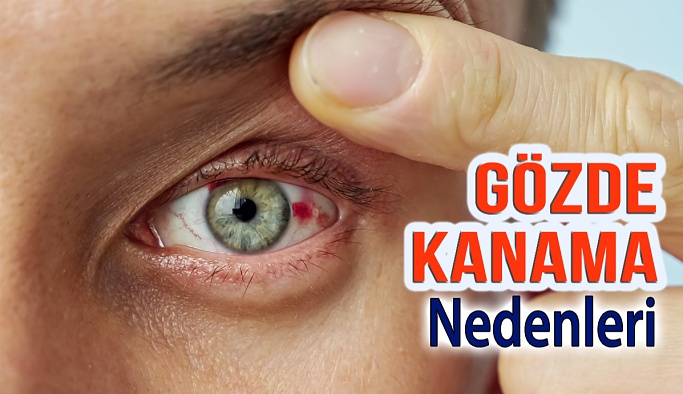 Gözde Kanama Neden Olur?