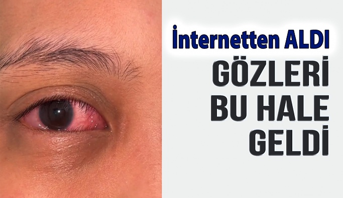 İnternetten Kontak Lens Aldı Gözleri Bu Hale Geldi