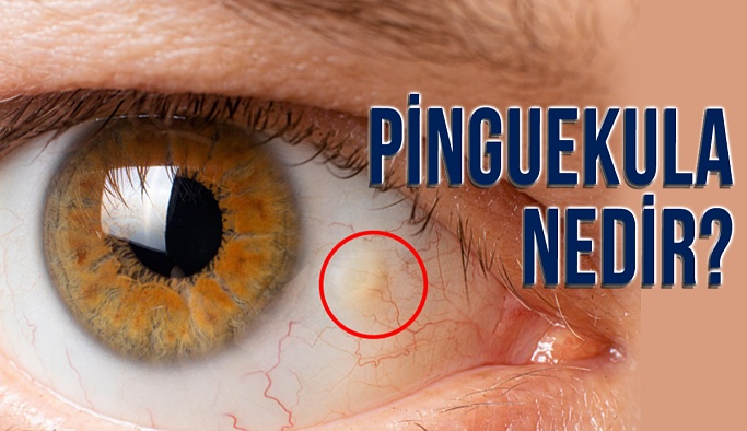 Pinguekula Nedir? Nasıl Tedavi Edilir?