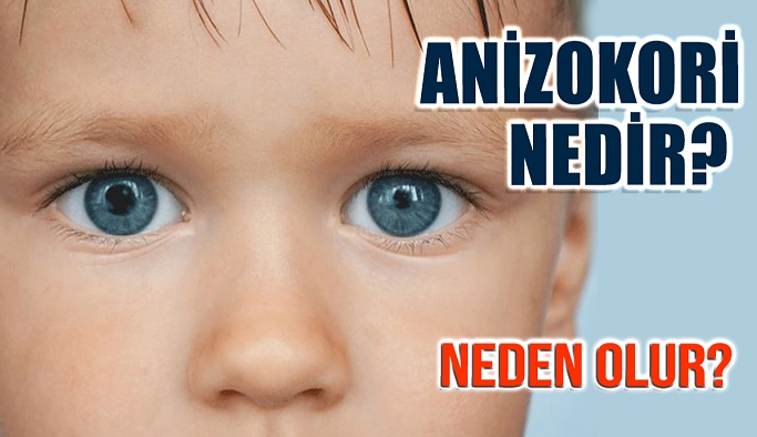 Anizokori Nedir? Neden Olur?