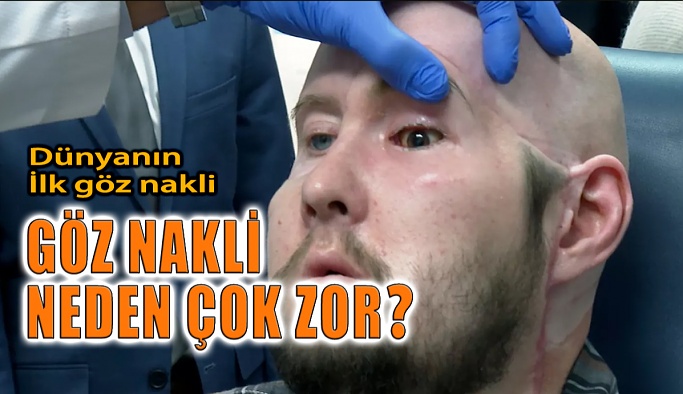 Göz Nakli Neden Çok Zor