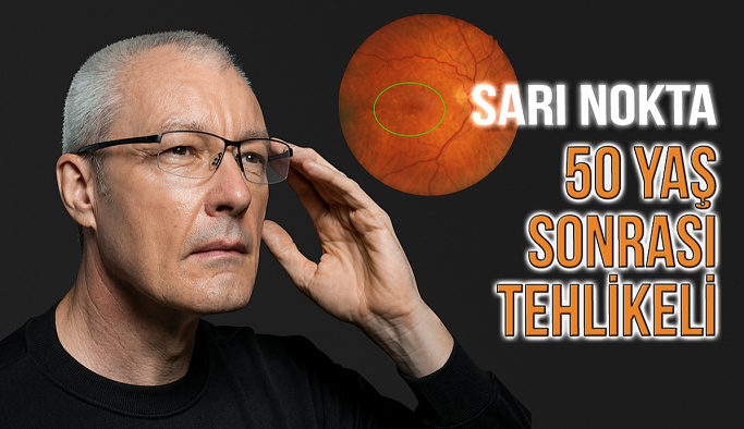 Gözde Sarı Nokta 50 Yaş Sonrası Tehlike Oluşturuyor