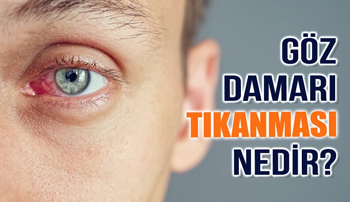 Göz Damarı Tıkanması Nedir?