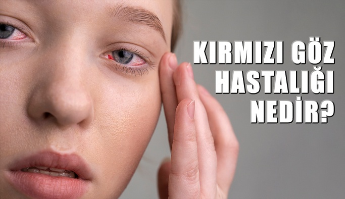 Kırmızı Göz Hastalığı Nedir?