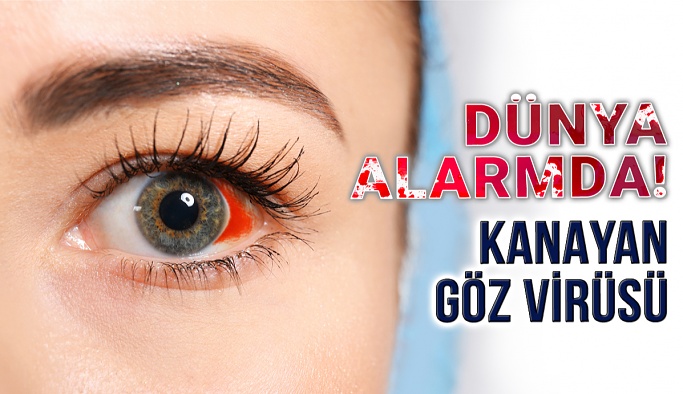 Dünya Alarmda "Kanayan Göz Virüsü"