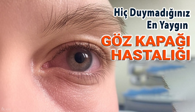 Hiç Duymadığınız En Yaygın Göz Kapağı Hastalığı