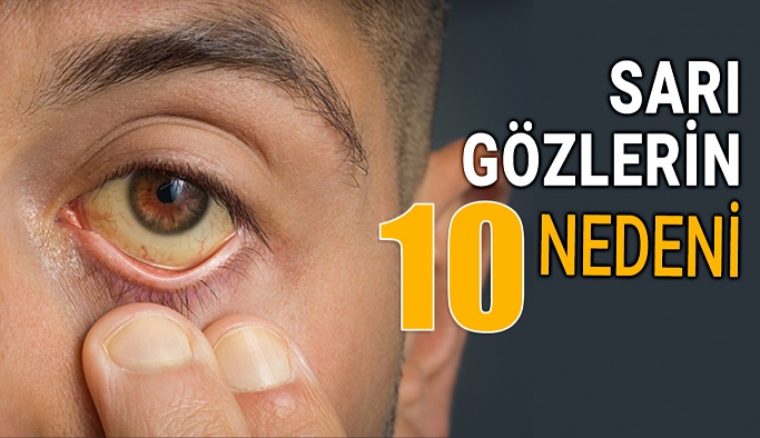 Sarı Gözlerin 10 Nedeni ve Tedavi Yöntemi