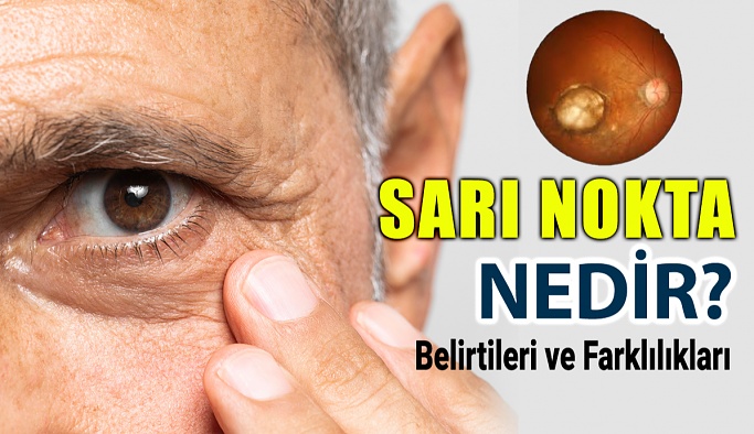 Sarı Nokta Hastalığı (Makula Dejenerasyonu) Nedir?