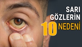 Sarı Gözlerin 10 Nedeni ve Tedavi Yöntemi