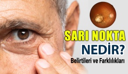 Sarı Nokta Hastalığı (Makula Dejenerasyonu) Nedir?