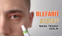 Blefarit nedir? Nasıl Tedavi Edilir?